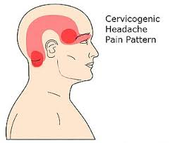 Cervicogenic Headache