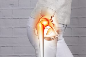 Read more about the article Hip Osteoarthritis