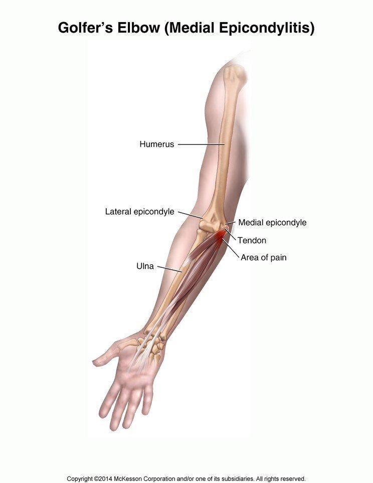 Medial Epicondylitis