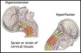 Neck Pain