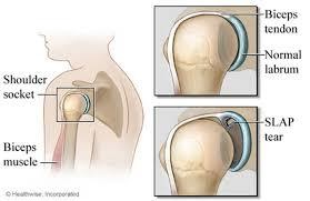 SLAP Tear