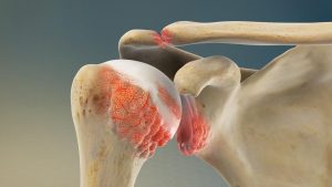 Shoulder Osteoarthritis