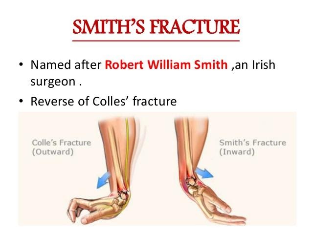 Smith Fracture