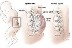 Spina Bifida