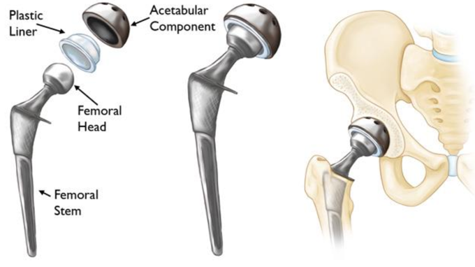 Total Hip Replacement