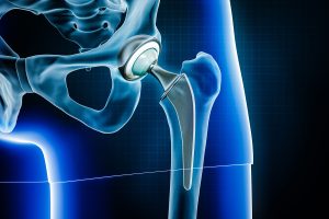 Read more about the article Total Hip Replacement