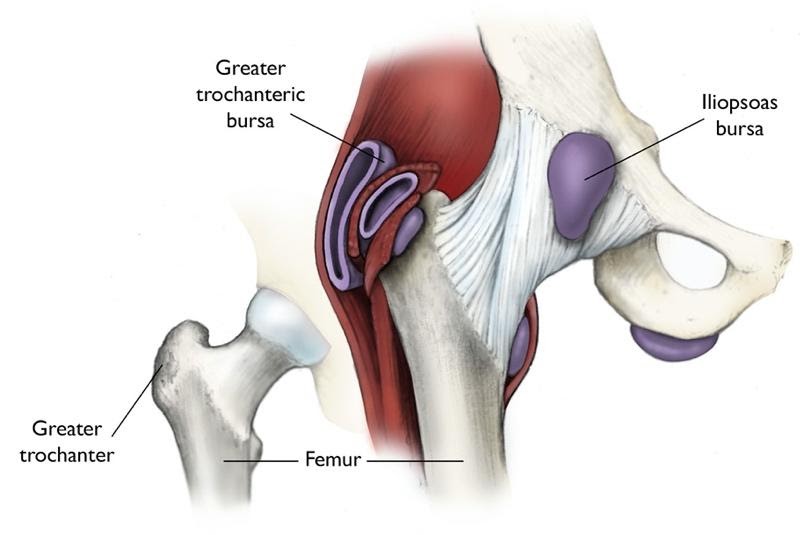 Trochanteric Bursitis